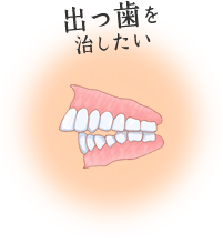 出っ歯を治したい