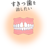 すきっ歯を治したい