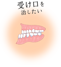 受け口を治したい
